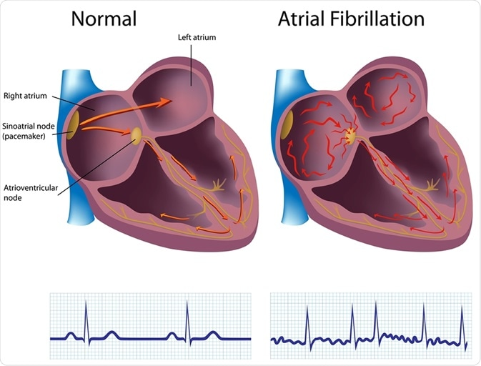 ATRIAL-FIBRILLATION-BLOG.png