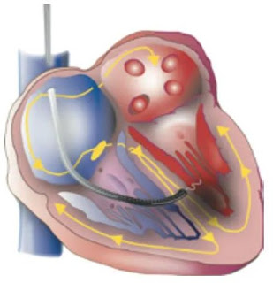 Benefits of Conduction System Pacing Over Traditional Pacing: A Breakthrough in Cardiac Care